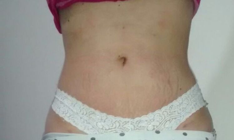 Tratamiento para las estrias y flacidez en el abdomen - 717