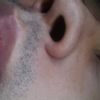 Cicatriz labio inferior - 991