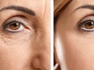 Resultados blefaroplastia