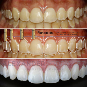 antes y después blanqueamiento dental