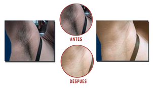 Antes y después de la depilación láser