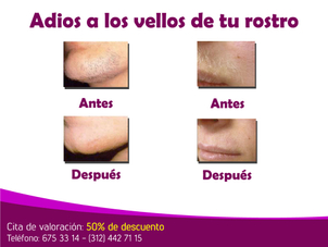 Paciente antes y después de depilación láser