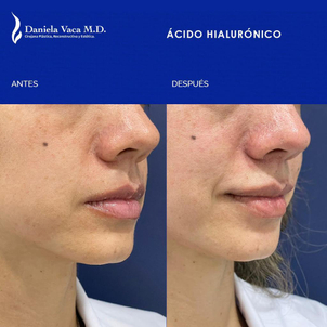 Antes y después aumento de labios