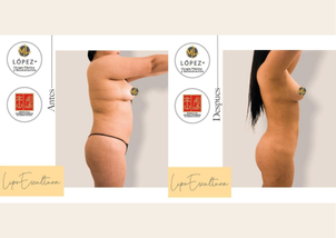 antes y después lipólisis láser