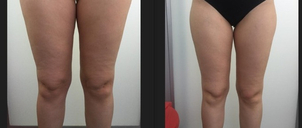 Resultados de la carboxiterapia