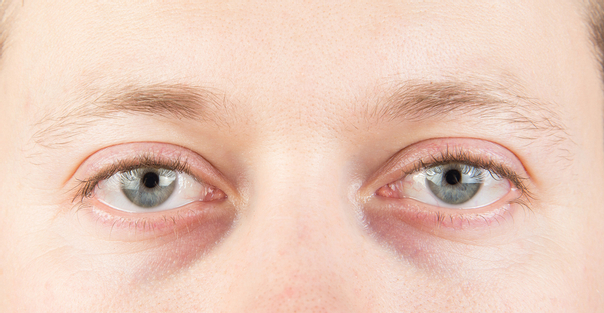 Efectos secundarios de bolsas en los ojos