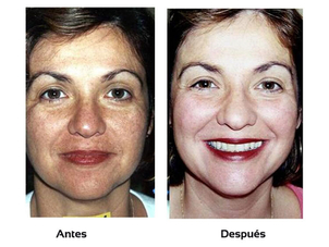 antes y después de microdermoabrasión