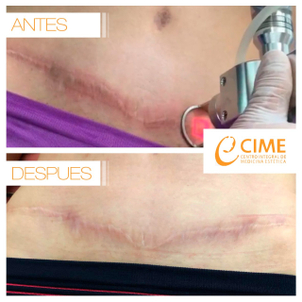 Antes y después de del tratamiento de cicatrices
