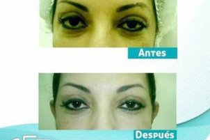antes y después ojeras