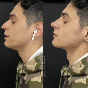 rinomodelacion antes y después