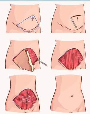 Paso a paso abdominoplastia