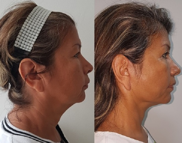 Antes y después de lifting facial 