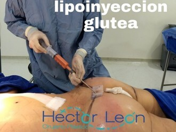 Lipoinyección glútea