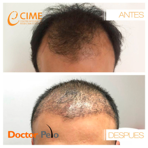 Resultados trasplante capilar