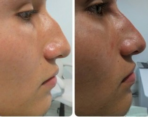 rinomodelacion antes y después