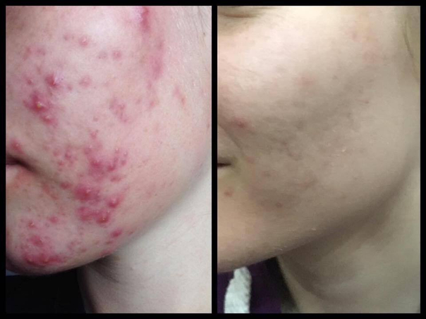 Antes y después de tratamiento acné