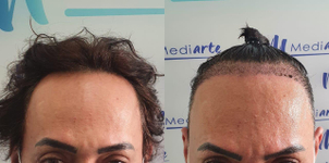 antes y después de implante de cabello
