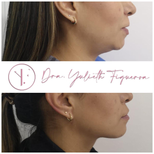 Mujer antes y después de su cirugía de papada