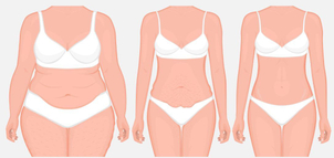 Tipos de abdominoplastia
