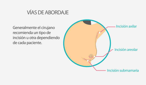 Incisiones aumento pecho