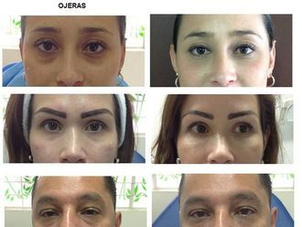 antes y después ojeras