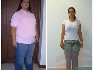 antes y después bypass gástrico