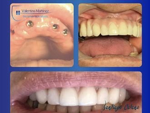 antes y después implantes