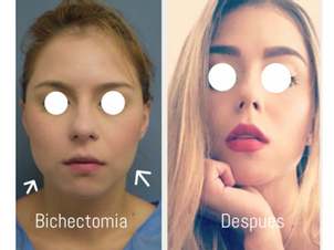 antes y después bolsas bichat
