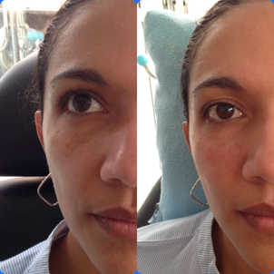 Resultados ácido hialurónico