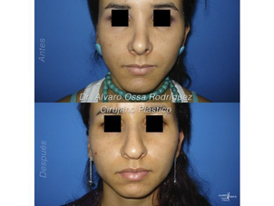 Resultados cirugía del mentón