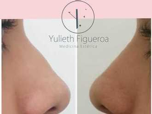 rinomodelacion antes y después