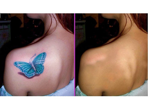 Eliminación de tatuajes