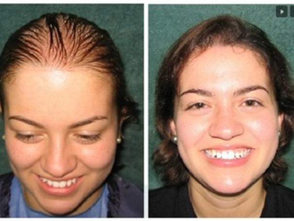 Tratamientos para la alopecia