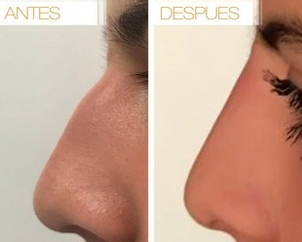 rinomodelacion antes y después