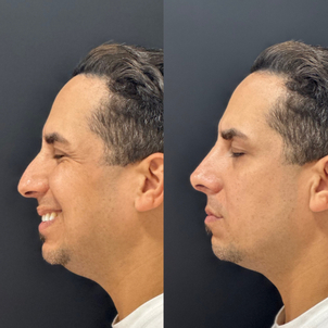 rinomodelacion antes y después