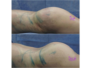 Imagen del pre y postoperatorio gluteoplastia