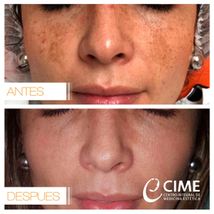 Antes y después de rejuvenecimiento facial