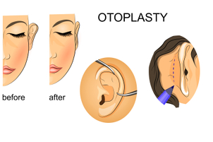 Alternativas a la otoplastia