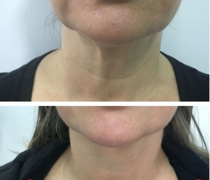 Ventajas de los hilos tensores