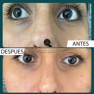 antes y después ojeras
