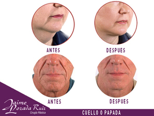 Antes y después mentoplastia