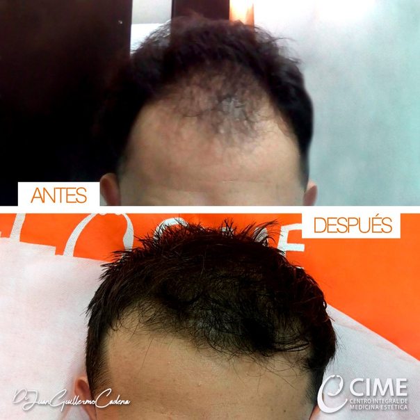 Antes y después trasplante de cabello 