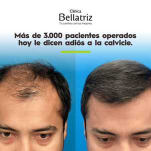 antes y después de implante de cabello