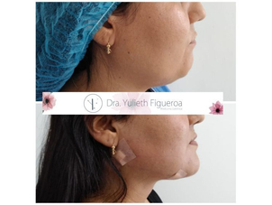 Antes y después aumento mentón