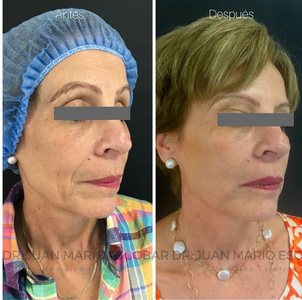 antes y después de rejuvenecimiento facial