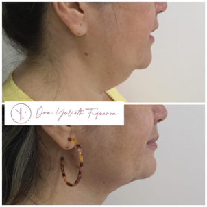 Mujer con y sin papada