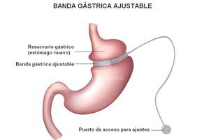 Banda gástrica