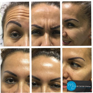 antes y después del bótox