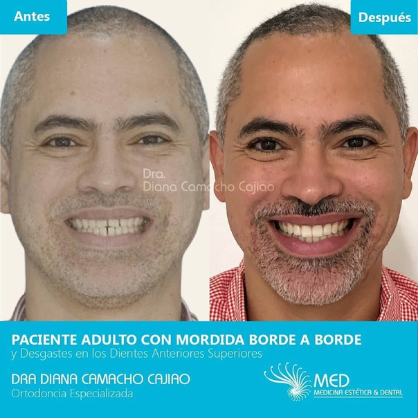 antes y después de ortodoncia 