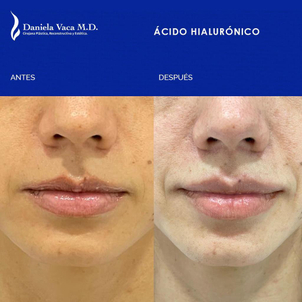 Primera cita aumento labios